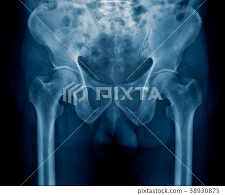 X-ray close up pelvic X-ray close up pelvic 38930875