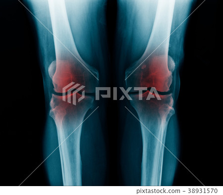 OA knee x-ray 38931570