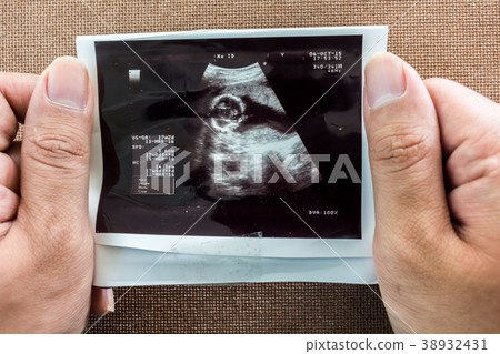 Photo of an ultrasound sonogram of an unborn baby 38932431