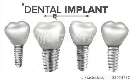 Dental Implant Set Vector. Implant Structure Dental Implant Set Vector. Implant Structure 38954787