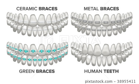 Braces Set Vector. Different Types. Human Jaw 38955411