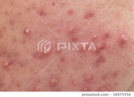 closeup skin problems, nodular cystic acne skin closeup skin problems, nodular cystic acne skin 38975456