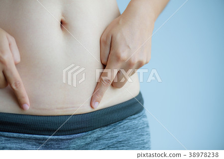 woman showing dark scar from a cesarean section. woman showing dark scar from a cesarean section. 38978238