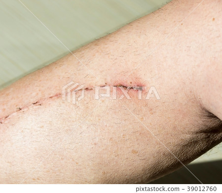 Male leg with scar from cardiac surgery Male leg with scar from cardiac surgery 39012760