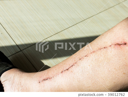 Male leg with scar from cardiac surgery Male leg with scar from cardiac surgery 39012762
