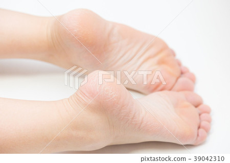 在一個女人的腳跟裂縫 39042310