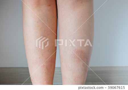 Dermatitis on the both of  women leg  39067615