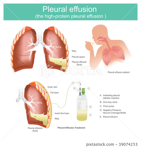 Pleural effusion the high-protein pleural effusion 39074253