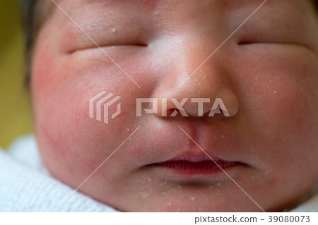 Baby acne Baby acne 39080073