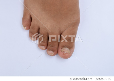 Fungus Infection on Nails of Asian women's Foot. w Fungus Infection on Nails of Asian women's Foot. w 39080220