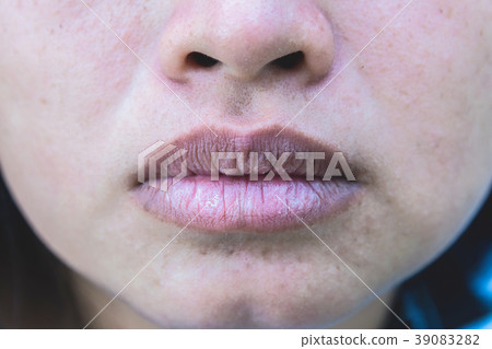 Mouth of asian woman with brittle and dry lips, Mouth of asian woman with brittle and dry lips, 39083282