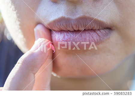 Mouth of asian woman with brittle and dry lips, 39083283
