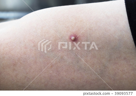 Big Whitehead Pimple, Zits, Acne on a Male Arm. 39093577
