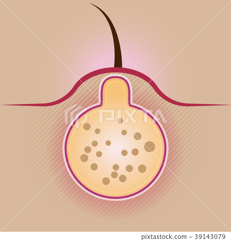 Acne skin inflammation. Medical illustration 39143079