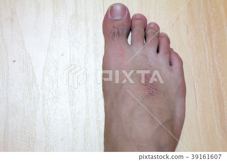 Dry skin and rash at male foot on wood background 39161607