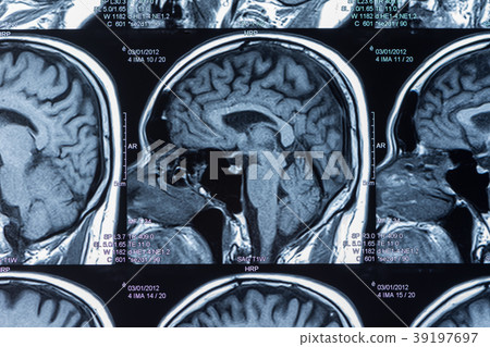 brain mri scan 39197697