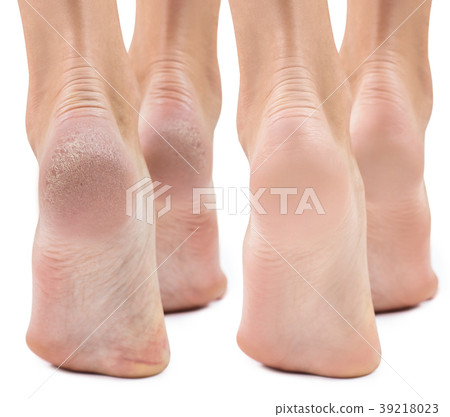 Feet with dry skin before and after treatment. Feet with dry skin before and after treatment. 39218023