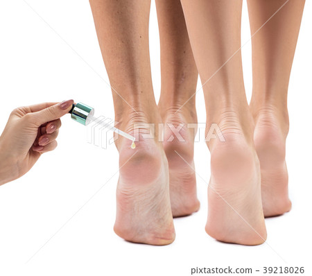 Feet with dry skin before and after treatment. 39218026