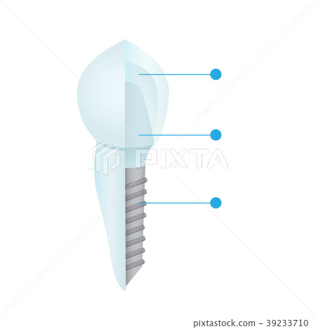 Dental crowns and implantation 39233710