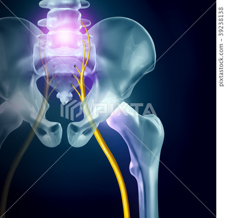 Sciatica Pain 39238138