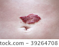 Capillary hemangioma regression. Red birthmark on 39264708