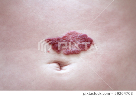 Capillary hemangioma regression. Red birthmark on Capillary hemangioma regression. Red birthmark on 39264708