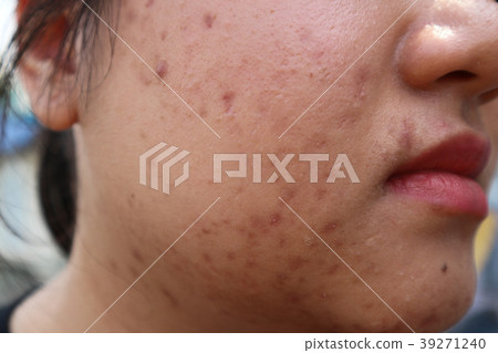 Close up of acne on skin woman Close up of acne on skin woman 39271240