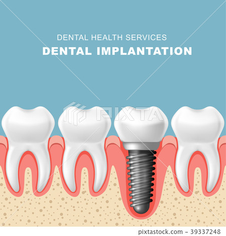 Dental implantation - row of teeth with implant Dental implantation - row of teeth with implant 39337248
