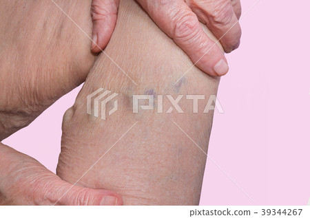 The varicose veins on a legs of old woman on 39344267