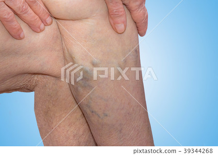 The varicose veins on a legs of old woman on blue 39344268