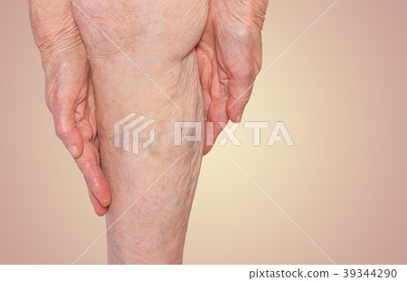 The varicose veins on a legs of old woman on 39344290
