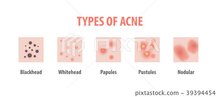 Types of acne diagram illustration vector on white 39394454