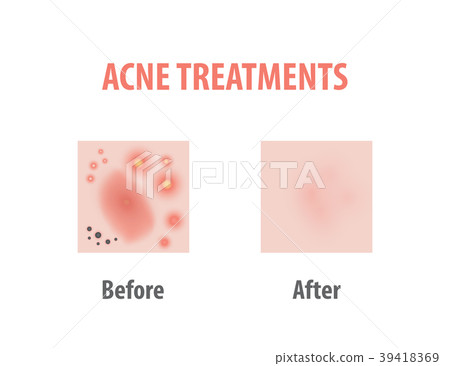 Acne treatments diagram illustration vector 39418369