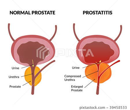 Prostatitis pathology poster 39458533