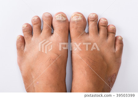 Psoriasis that Pedicure on white background Psoriasis that Pedicure on white background 39503399