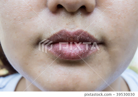 Dry mouth , dry lip Skin peeling Dry mouth , dry lip Skin peeling 39530030