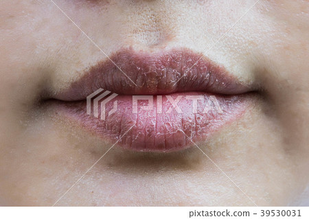 Dry mouth , dry lip Skin peeling 39530031