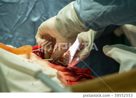 removal of a malignant tumor 39552553