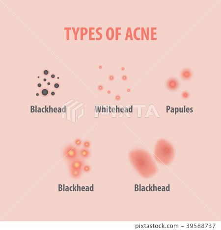 Types of acne illustration vector Types of acne illustration vector 39588737