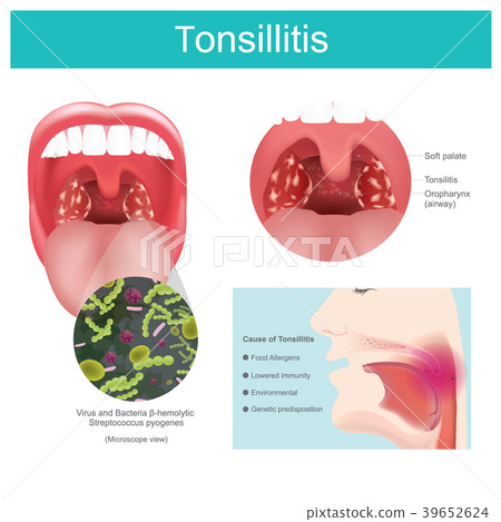 Tonsillitis 39652624