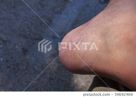 Fungus on foot. 39692469