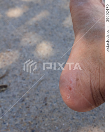 Fungus on foot. Fungus on foot. 39692470