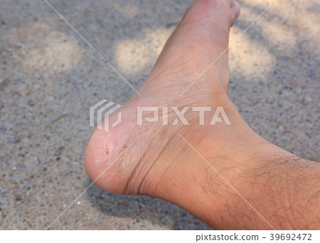 Fungus on foot. Fungus on foot. 39692472