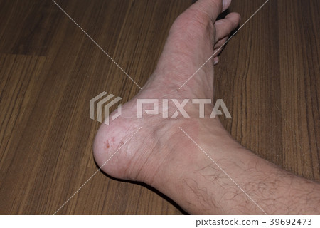 Fungus on foot. Fungus on foot. 39692473