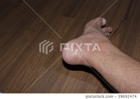 Fungus on foot. Fungus on foot. 39692474