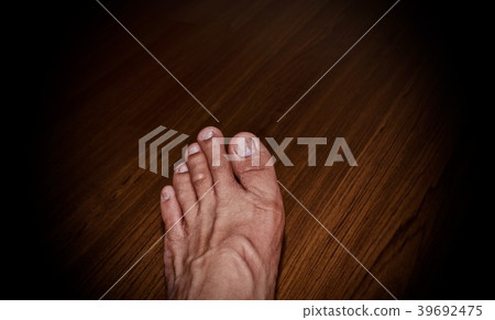 Cracks on the toenail. Cracks on the toenail. 39692475