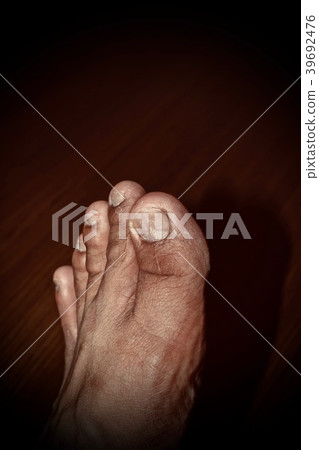 Cracks on the toenail. Cracks on the toenail. 39692476