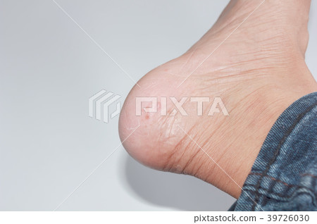 Foot fungus on a white background Foot fungus on a white background 39726030