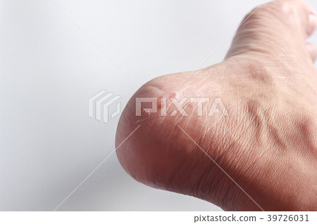Foot fungus on a white background Foot fungus on a white background 39726031