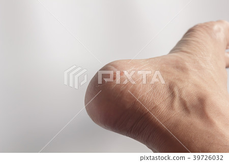 Foot fungus on a white background Foot fungus on a white background 39726032